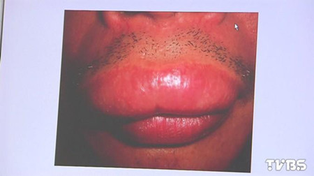 男子狂吃3天海鮮變香腸嘴上唇比下唇大出1倍(圖)